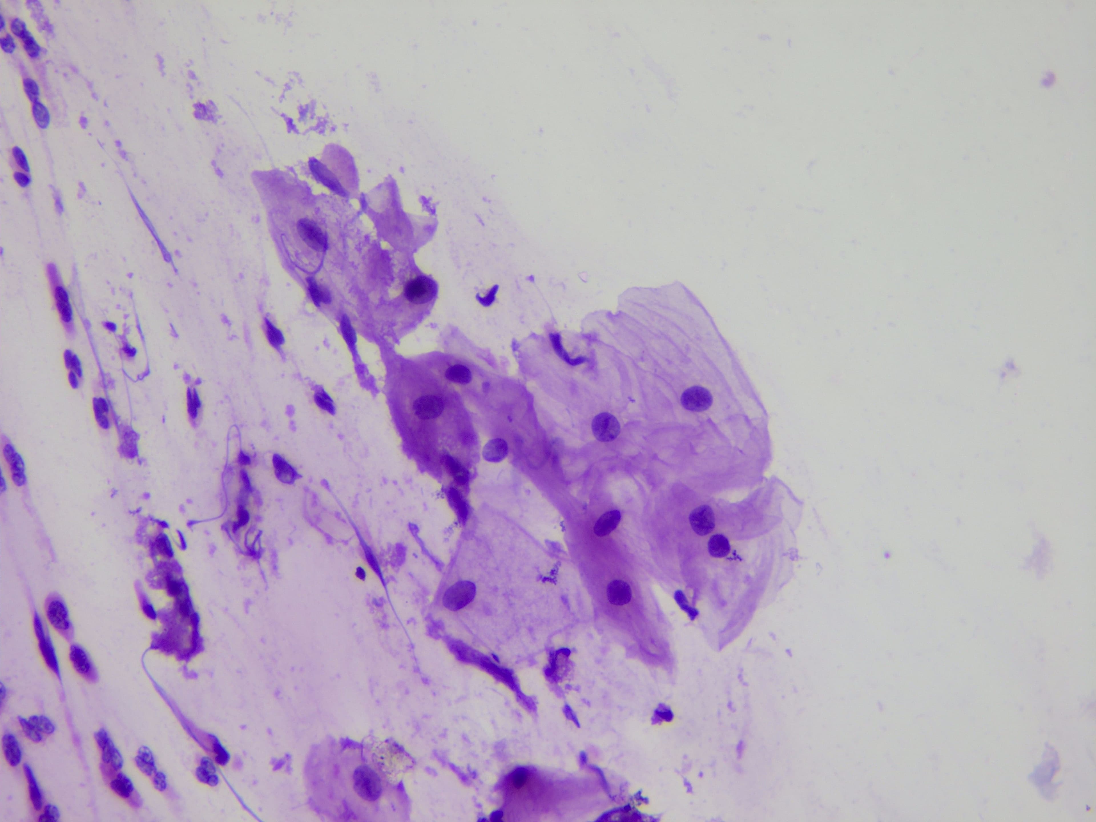ASC-US microscopy sample