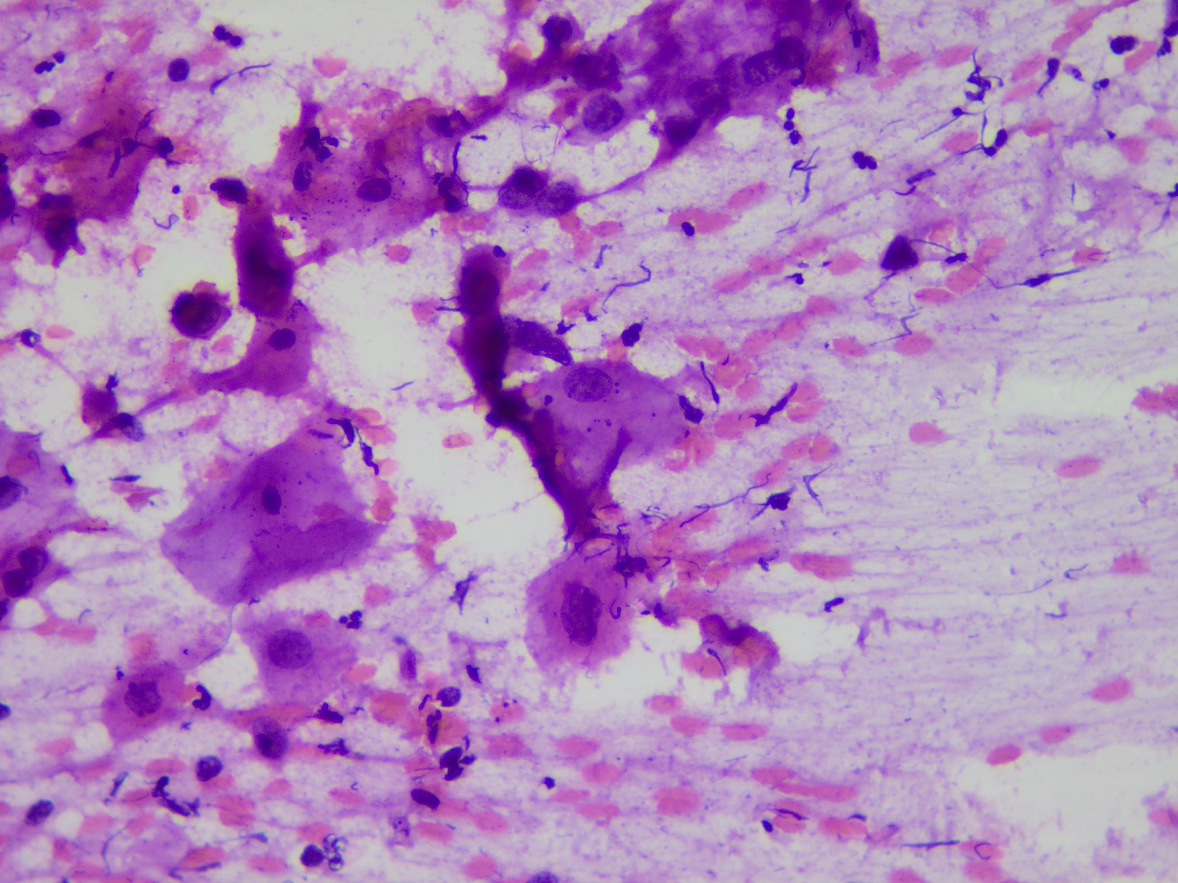 HSIL microscopy sample