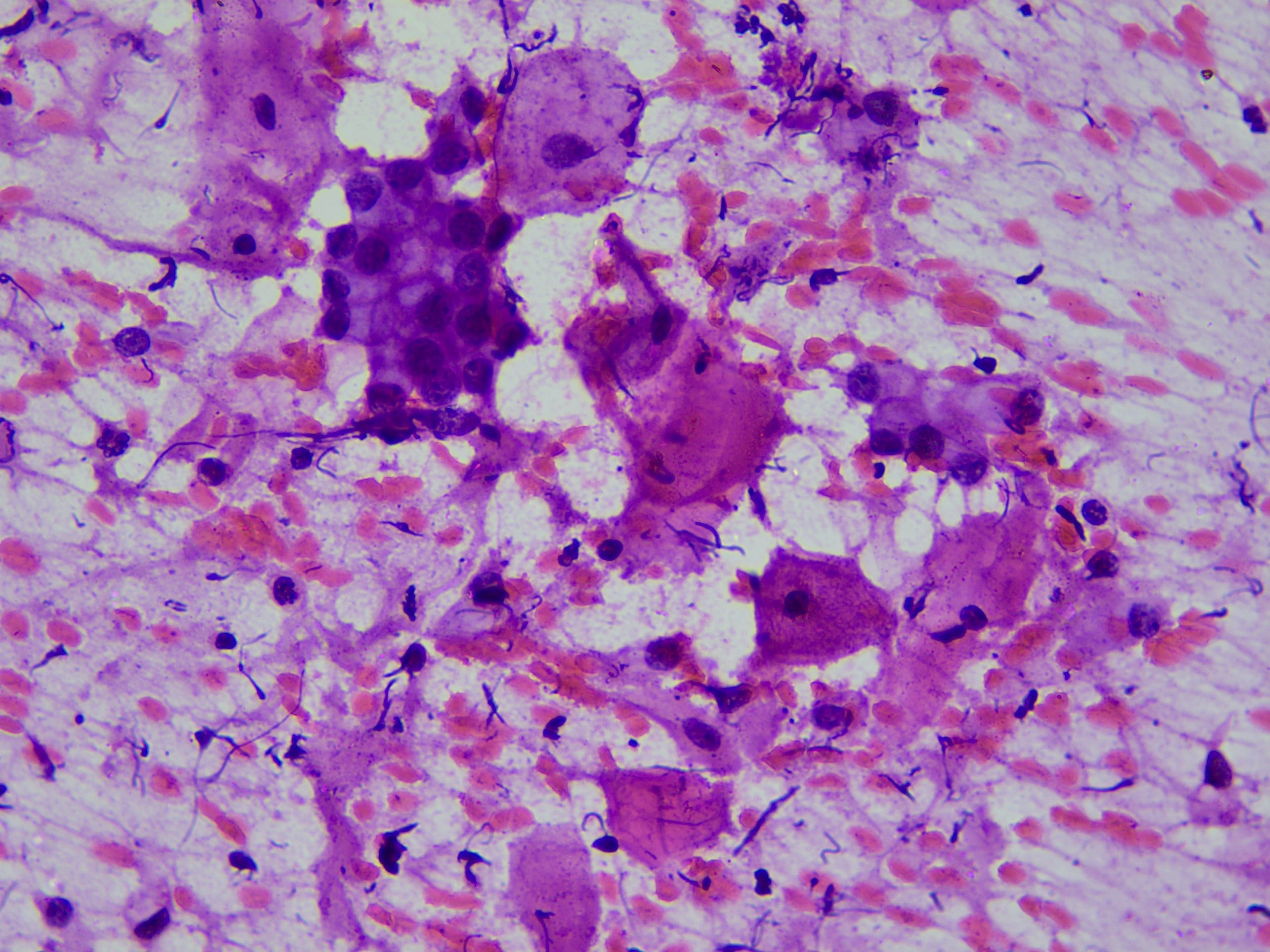 LSIL microscopy sample